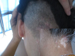 颈部白癜风